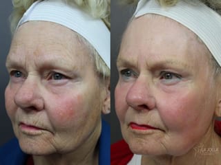 Before and after Ablative Laser Treatment case 36319 - Angle 1