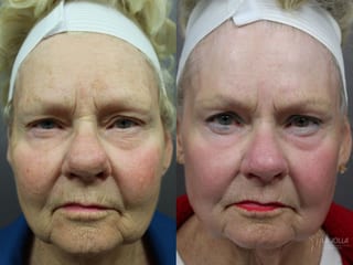 Before and after Ablative Laser Treatment case 36319 - Angle 3