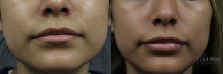 Before and after Lip Filler case 36321 - Angle 1