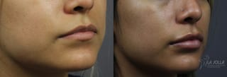 Before and after Lip Filler case 36321 - Angle 2