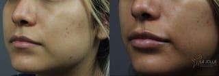 Before and after Lip Filler case 36321 - Angle 3