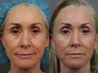 Before and after Ablative Laser Treatment case 36323 - Angle 1