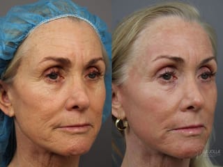 Before and after Ablative Laser Treatment case 36323 - Angle 2
