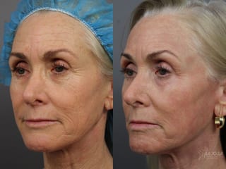 Before and after Ablative Laser Treatment case 36323 - Angle 3