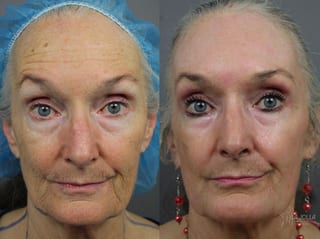 Before and after Ablative Laser Treatment case 36324 - Angle 1
