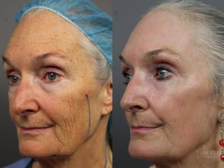 Before and after Ablative Laser Treatment case 36324 - Angle 2