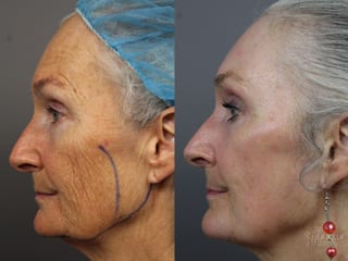 Before and after Ablative Laser Treatment case 36324 - Angle 3
