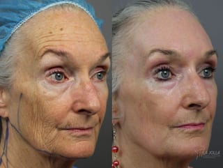 Before and after Ablative Laser Treatment case 36324 - Angle 4