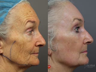 Before and after Ablative Laser Treatment case 36324 - Angle 5