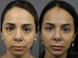 Before and after Sculptra® case 36341 - Angle 1