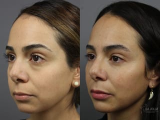 Before and after Sculptra® case 36341 - Angle 2