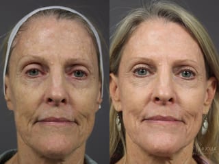 Before and after Ablative Laser Treatment case 36342 - Angle 1