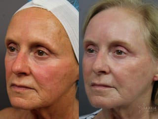 Before and after Ablative Laser Treatment case 36343 - Angle 1