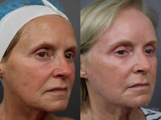 Before and after Ablative Laser Treatment case 36343 - Angle 2