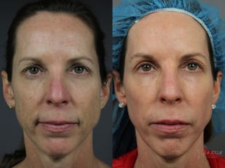 Before and after Sculptra® case 36363 - Angle 1