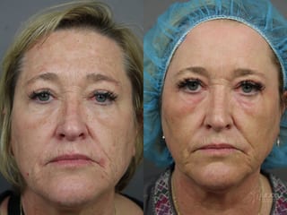 Before and after Ablative Laser Treatment case 36364 - Angle 1