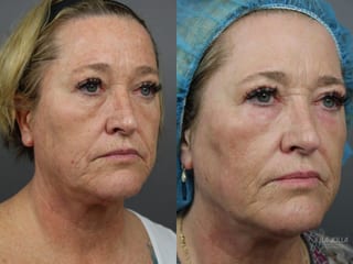 Before and after Ablative Laser Treatment case 36364 - Angle 2