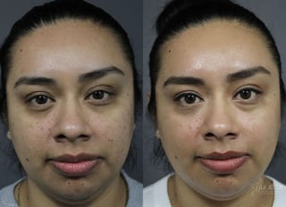 Before and after Dermatosis Papulosa Nigra (DPN) case 36382 - Angle 1