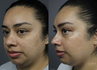 Before and after Dermatosis Papulosa Nigra (DPN) case 36382 - Angle 2