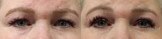 Before and after Blepharoplasty case 36383 - Angle 1