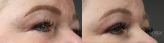Before and after Blepharoplasty case 36383 - Angle 2