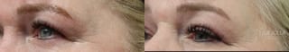 Before and after Blepharoplasty case 36383 - Angle 3