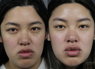 Before and after Dermatosis Papulosa Nigra (DPN) case 36393 - Angle 1