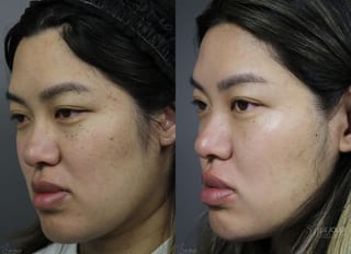 Before and after Dermatosis Papulosa Nigra (DPN) case 36393 - Angle 2