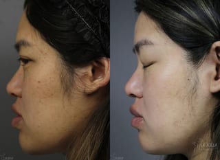 Before and after Dermatosis Papulosa Nigra (DPN) case 36393 - Angle 3