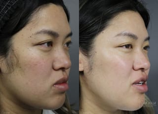 Before and after Dermatosis Papulosa Nigra (DPN) case 36393 - Angle 4