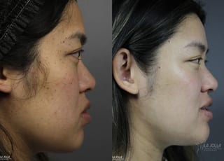 Before and after Dermatosis Papulosa Nigra (DPN) case 36393 - Angle 5