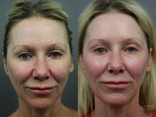Before and after 6D Platinum Laser Lift case 36397 - Angle 1
