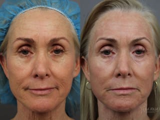 Before and after Laser Skin Resurfacing case 36399 - Angle 1