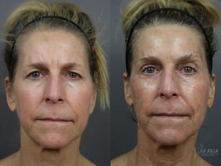 Before and after 6D Platinum Laser Lift case 36400 - Angle 1