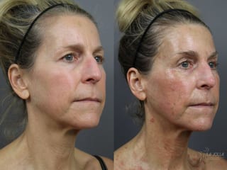 Before and after 6D Platinum Laser Lift case 36400 - Angle 2