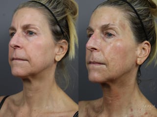 Before and after 6D Platinum Laser Lift case 36400 - Angle 3