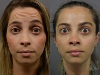 Before and after BOTOX® case 36401 - Angle 1