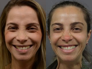 Before and after BOTOX® case 36401 - Angle 2