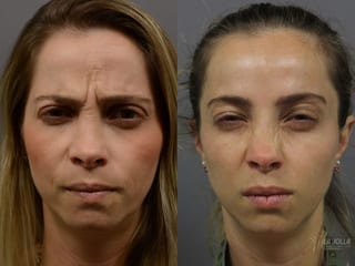 Before and after BOTOX® case 36401 - Angle 3