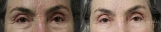 Before and after Fractional CO2 case 36402 - Angle 1