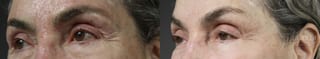 Before and after Fractional CO2 case 36402 - Angle 2