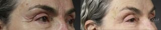 Before and after Fractional CO2 case 36402 - Angle 3
