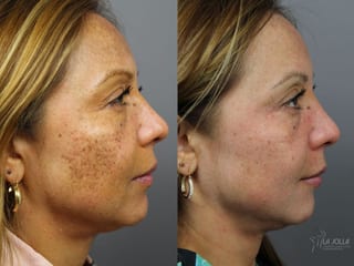 Before and after Skin Care Products case 36403 - Angle 1