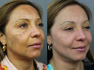 Before and after Skin Care Products case 36403 - Angle 2