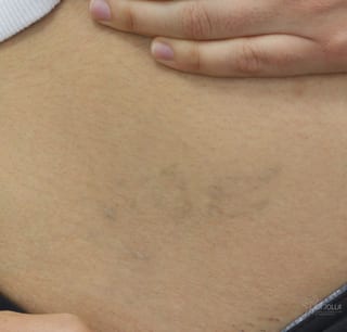 Before and after Tattoo Removal case 36424 - Angle 2