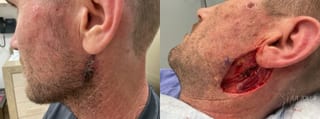 Before and after Mohs Surgery case 36430 - Angle 1
