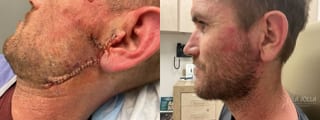 Before and after Mohs Surgery case 36430 - Angle 2