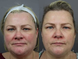 Before and after IPL case 36440 - Angle 1