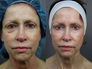 Before and after 6D Platinum Laser Lift case 36441 - Angle 1
