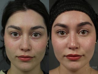 Before and after PRP Liquid Facelift case 36443 - Angle 1